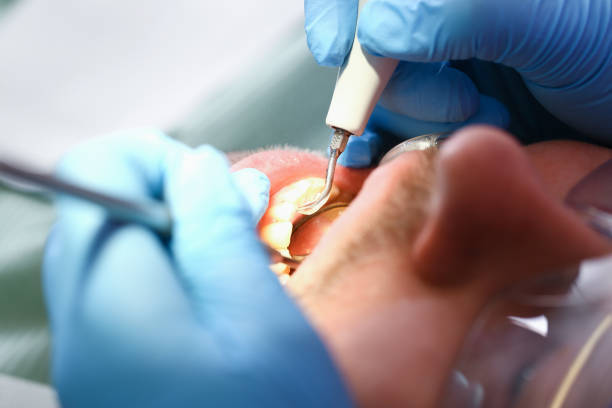 Best Emergency Dental Care for Broken or Chipped Teeth in Chester, MD